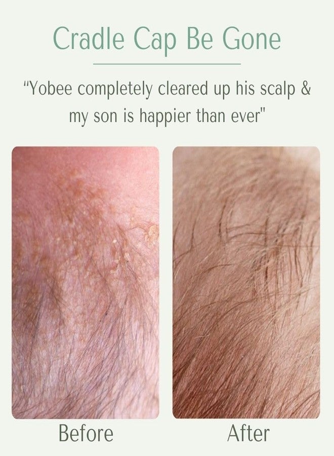 Yobee Ultra Gentle Soothing Scalp Mask - Dry Scalp Treatment Hair Mask Safe For Sensitive Baby Skin - Probiotic Infused - For Sensitive Scalp & Cradle Cap - For Babies, 4 fl oz - Image 2
